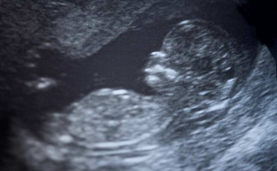 Plannig familial Etats-Unis vente organes foetus minimiser scandale