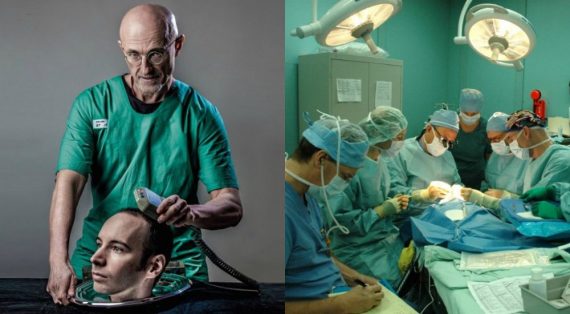 Transplantation tête homme Chine