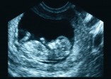 Etats-Unis : une militante pro-choix affirme que les avortements ne sont pas assez nombreux