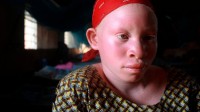 Tanzanie vendre niece albinos magie noire