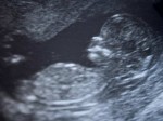 Le Planning familial des Etats-Unis et la vente d’organes de fœtus : comment on essaie de minimiser le scandale