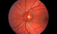 Google “Deep Mind” entame le dépistage d’un million de scans oculaires du NHS britannique