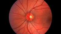 Google Deep Mind NHS scans oculaires dépistage