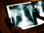 Au moins 1.555 réfugiés atteints de tuberculose active sur le sol des Etats-Unis<br>– et en France ?