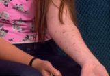 Des brûlures sur tout le bras, à 12 ans, à cause du jeu du déodorant