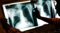 Les migrants en provenance de la Corne d’Afrique présentent une incidence inquiétante de la tuberculose multirésistante (“The Lancet”)