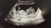 Irlande avortement pas assez scanners detecter anomalies