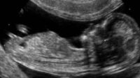 Les NIH américains interdisent le financement de recherches utilisant des bébés avortés
