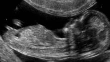 NIH recherches bébés avortés