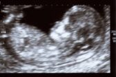 Dans le Wisconsin, Planned Parenthood va suspendre les avortements