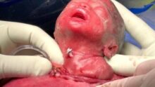bébé opéré ventre mère